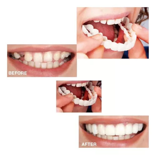 ✨Carillas Dentales - Tu nueva sonrisa perfecta sin dentista, sin agujas y sin gastar una fortuna.