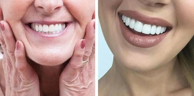 ✨Carillas Dentales - Tu nueva sonrisa perfecta sin dentista, sin agujas y sin gastar una fortuna.