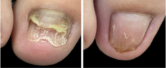 ✨ Tratamiento antifúngico y para uñas encarnadas – ToenailPlus 💅🌿💥