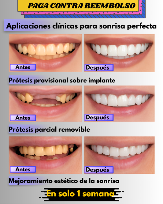 ✨Carillas Dentales - Tu nueva sonrisa perfecta sin dentista, sin agujas y sin gastar una fortuna.
